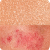 SKIN DAMAGE